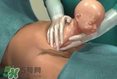 剖腹产的过程 剖腹产的步骤及时间