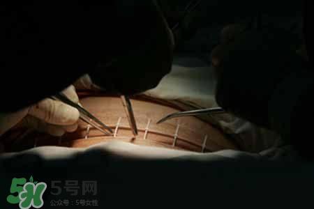 剖腹产的过程 剖腹产的步骤及时间