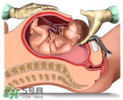 剖腹产的过程 剖腹产的步骤及时间