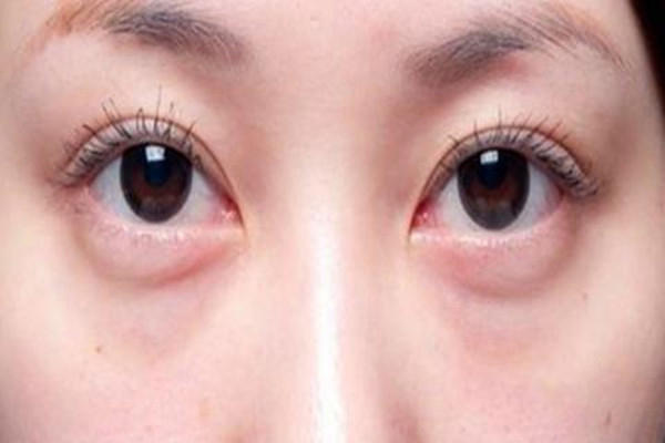 眼袋出现的原因 韩式去眼袋有效果吗