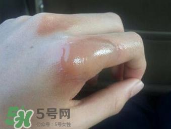 烫伤可以用牙膏吗？烫伤用牙膏管用吗？