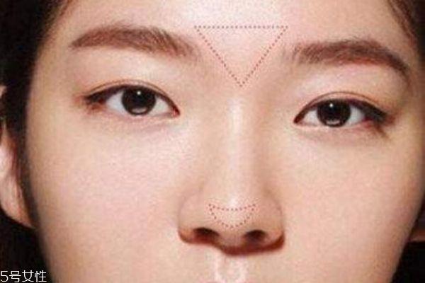 膨体隆鼻材料介绍 国产膨体品牌