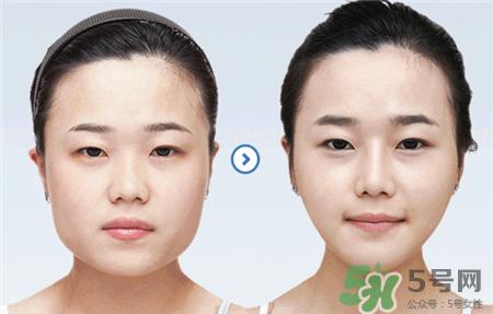 保妥适瘦脸针多少钱?botox瘦脸针一般价格