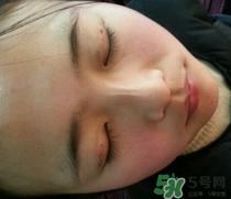 埋线双眼皮需要拆线吗？埋线双眼皮怎么拆线