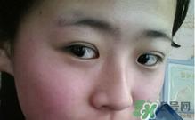 埋线双眼皮需要拆线吗?埋线双眼皮怎么拆线