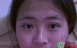 埋线双眼皮需要拆线吗？埋线双眼皮怎么拆线