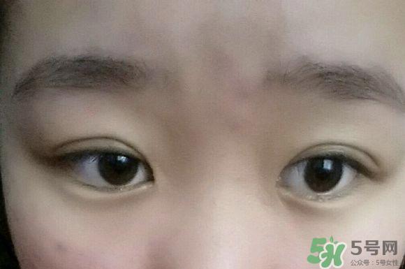 埋线双眼皮需要拆线吗？埋线双眼皮怎么拆线