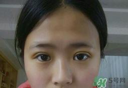 埋线双眼皮需要拆线吗？埋线双眼皮怎么拆线