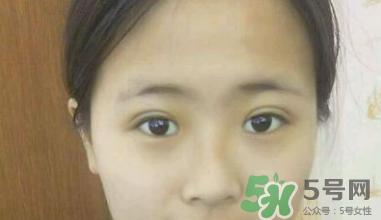 埋线双眼皮需要拆线吗？埋线双眼皮怎么拆线