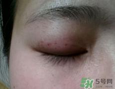 埋线双眼皮需要拆线吗？埋线双眼皮怎么拆线