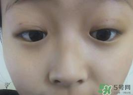 埋线双眼皮需要拆线吗？埋线双眼皮怎么拆线