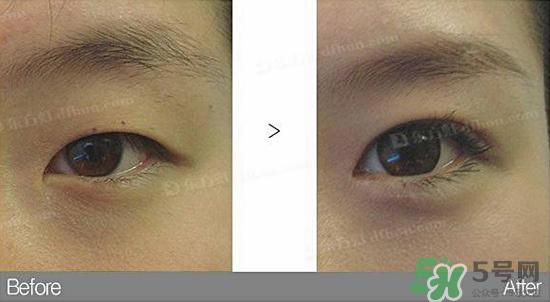 埋线双眼皮需要拆线吗？埋线双眼皮怎么拆线