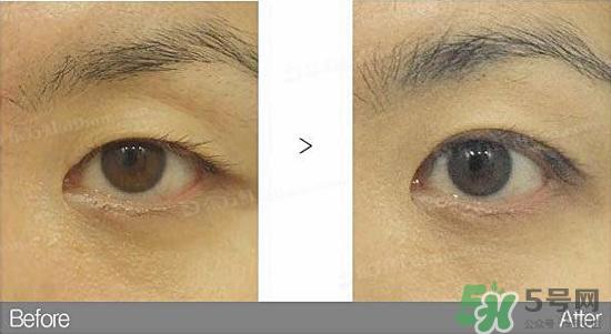 埋线双眼皮需要拆线吗?埋线双眼皮怎么拆线