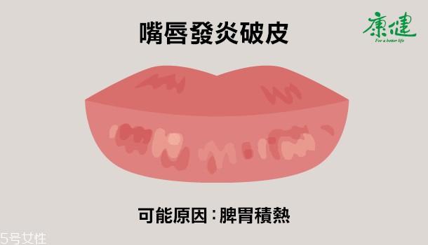 ​嘴唇发黑发紫是什么原因 6种唇色解读