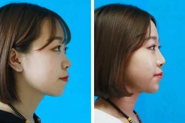 自体脂肪丰下巴好不好 自体脂肪丰下巴效果怎么样