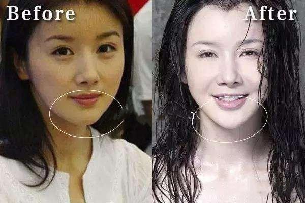 自体脂肪丰下巴好不好 自体脂肪丰下巴效果怎么样