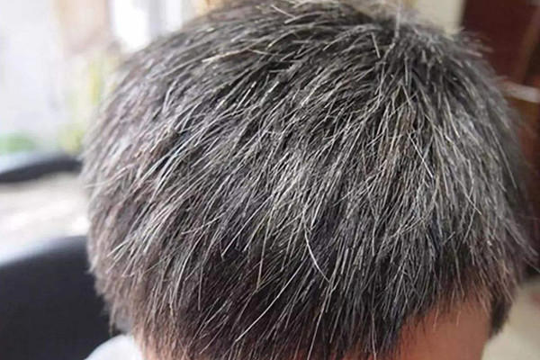 年轻人长白发是什么原因 年轻人长白头发怎么解决