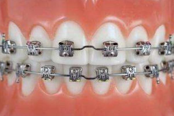 牙套是隐形的好还是钢丝的好 牙套是怎么做上去的
