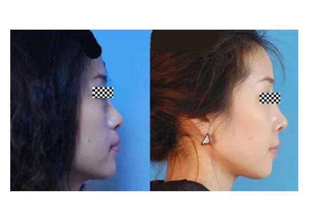 膨体隆鼻感染有什么症状 膨体隆鼻感染几率