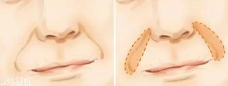 鼻唇沟填充用什么方法 鼻唇沟填充显年轻吗