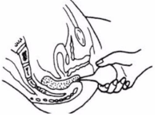 开塞露躺着还是蹲着用？开塞露使用姿势