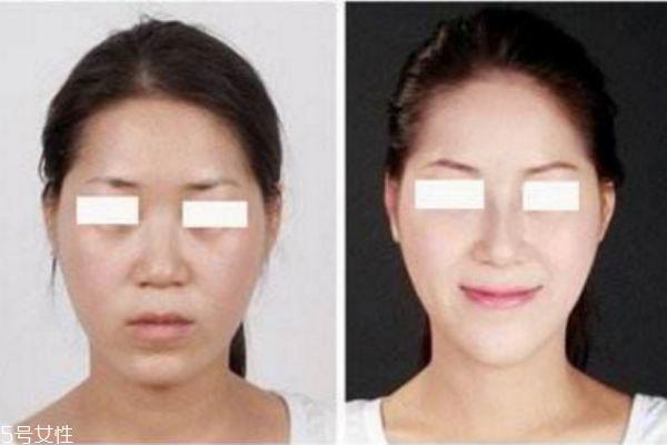 垫下巴前后对比照片 垫下巴的优缺点