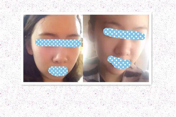 垫下巴前后对比照片 垫下巴的优缺点