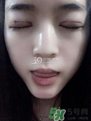 什么是定点双眼皮？定点双眼皮多少钱？