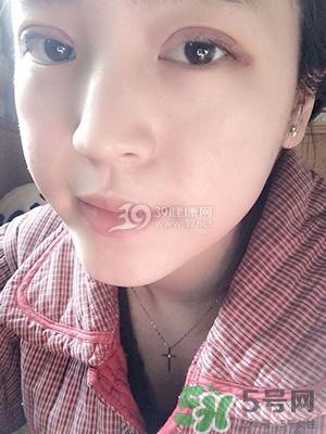 什么是定点双眼皮？定点双眼皮多少钱？