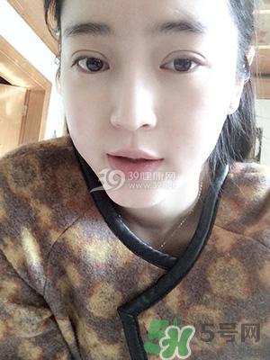 什么是定点双眼皮？定点双眼皮多少钱？