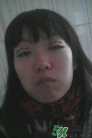 什么是定点双眼皮？定点双眼皮多少钱？