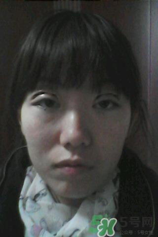 什么是定点双眼皮？定点双眼皮多少钱？