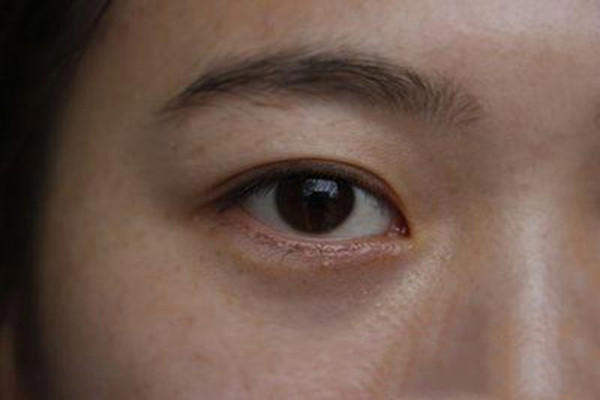 ​无痕去眼袋真的无痕吗 无痕去眼袋术前注意事项 ​