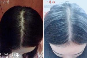 柳屋生发水有用吗?一个月后长出新发