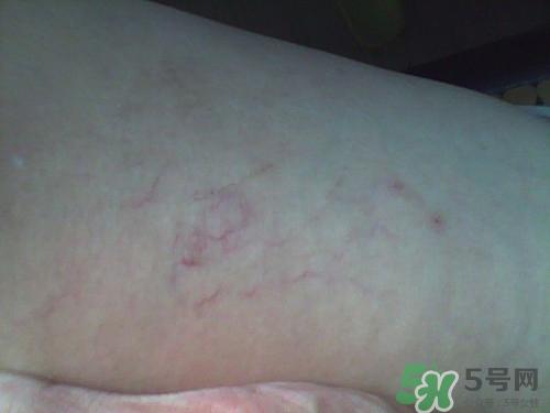 腿上有血丝是怎么回事?腿上有血丝怎么消除