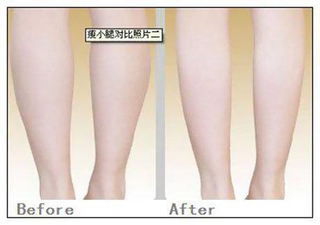 小腿肌肉可以抽脂减肥吗 小腿抽脂减肥的注意事项