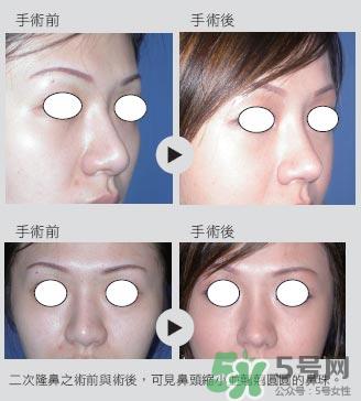 二次隆鼻注意事项_第二次隆鼻直接做吗