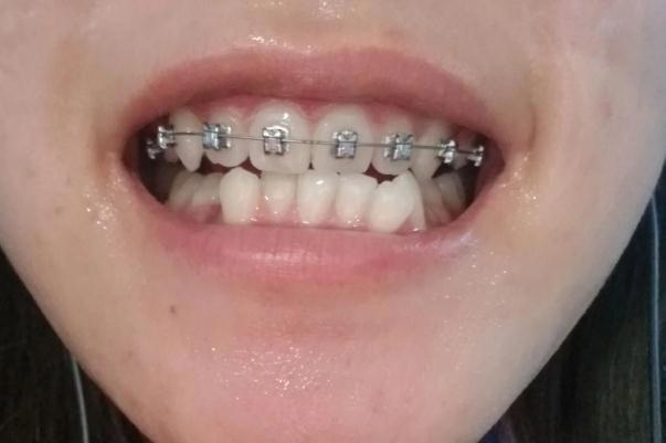 牙套多大年龄可以戴 3岁小孩可以戴牙套吗