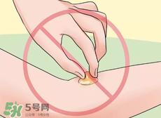 水泡怎么处理?水泡要不要刺破?