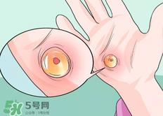 水泡怎么处理?水泡要不要刺破?