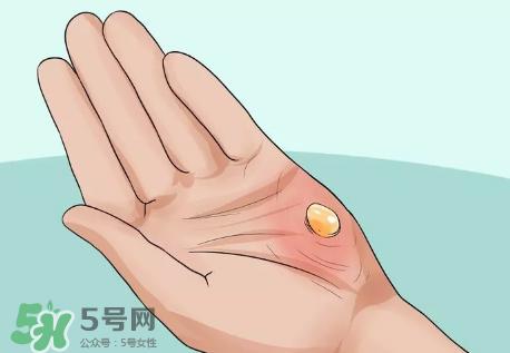 水泡怎么处理?水泡要不要刺破?