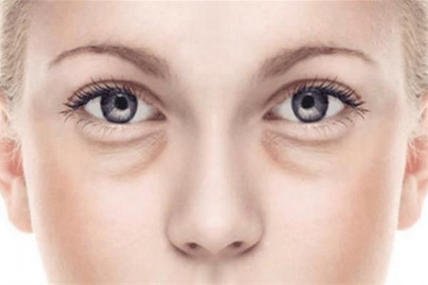 黑眼圈和眼袋有什么区别 黑眼圈和眼袋的区别