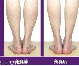 瘦小腿手术价格多少 瘦小腿手术很贵吗