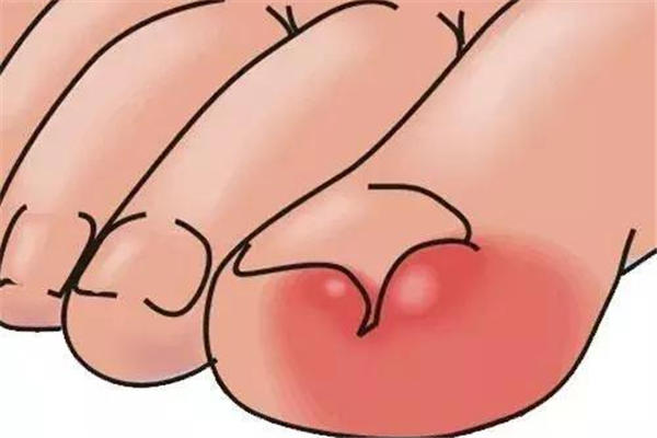 甲沟炎自己化脓了怎么处理 甲沟炎化脓怎么治疗最好