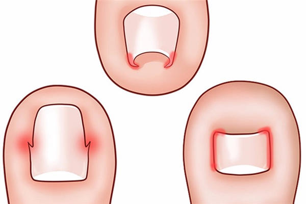 甲沟炎自己化脓了怎么处理 甲沟炎化脓怎么治疗最好