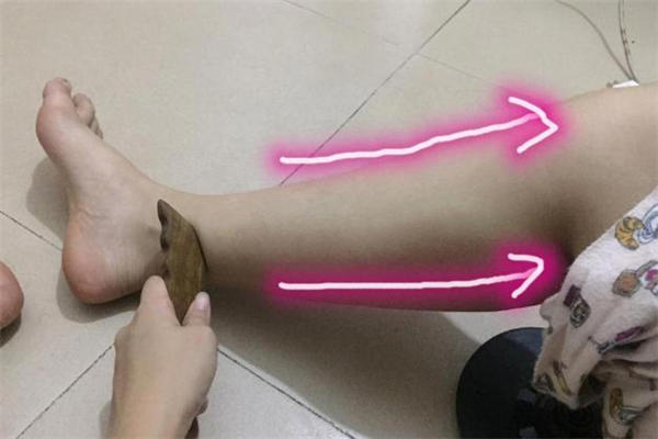 刮痧减肥的原理 刮痧减肥的正确方法