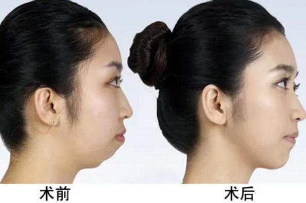 丰下巴用大分子还是小分子 丰下巴有几种方法