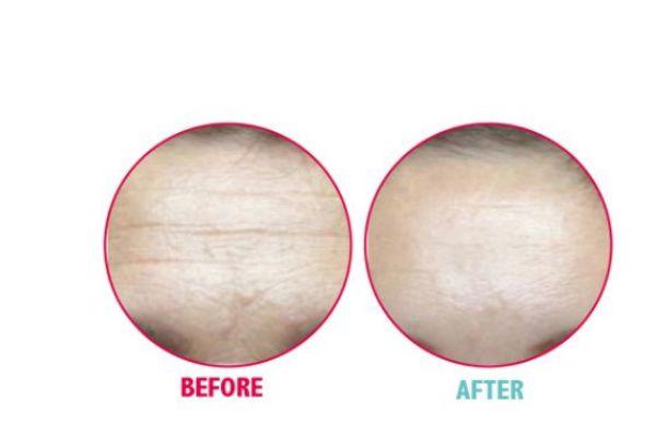 打一次除皱针可以维持多久呢 一针除皱针需要多少钱呢