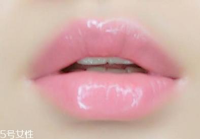 嘟嘟唇可以接吻吗 恢复后就可以