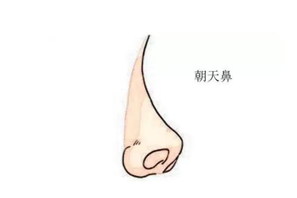 朝天鼻矫正一般多少钱 朝天鼻矫正风险大吗